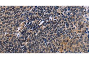 Immunohistochemistry of paraffin-embedded Human cervical cancer tissue using FSTL1 Polyclonal Antibody at dilution 1:30 (FSTL1 抗体)