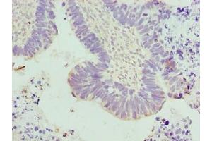 Immunohistochemistry of paraffin-embedded human ovarian cancer using ABIN7173667 at dilution of 1:100 (TUBA3E 抗体  (AA 1-250))