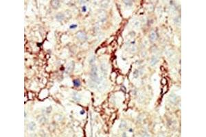 IHC analysis of FFPE human breast carcinoma tissue stained with the FGFR3 antibody (FGFR3 抗体  (AA 776-806))