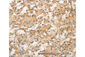 Immunohistochemistry of Human prostate cancer using STAM Polyclonal Antibody at dilution of 1:40 (STAM 抗体)