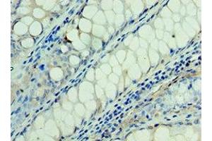 Immunohistochemistry of paraffin-embedded human colon cancer using ABIN7166935 at dilution of 1:100 (RSPO1 抗体  (AA 21-263))