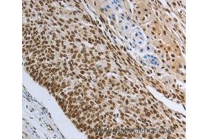 Immunohistochemistry of Human colon cancer using PRMT3 Polyclonal Antibody at dilution of 1:30 (PRMT3 抗体)