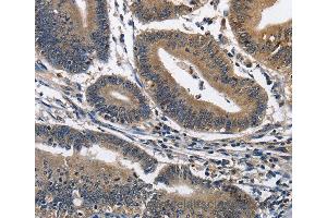 Immunohistochemistry of Human colon cancer using IL2RB Polyclonal Antibody at dilution of 1:60 (IL2 Receptor beta 抗体)