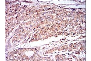 Immunohistochemical analysis of paraffin-embedded prostate cancer tissues using CAMK2G mouse mAb with DAB staining. (CAMKII gamma 抗体  (AA 322-481))