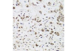 Immunohistochemistry of paraffin-embedded human gastric cancer using PPP1CC antibody. (PPP1CC 抗体  (AA 1-323))