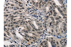 The image on the left is immunohistochemistry of paraffin-embedded Human ovarian cancer tissue using ABIN7190002(BPIFB1 Antibody) at dilution 1/40, on the right is treated with synthetic peptide. (BPIFB1 抗体)