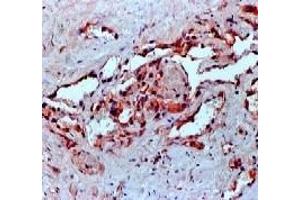 Formalin fixed paraffin embedded human angiosarcoma stained with VEGF antibody (VEGFA 抗体)