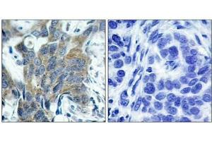 Immunohistochemical analysis of paraffin-embedded human breast carcinoma tissue using b-Catenin(Phospho-Ser33) Antibody(left) or the same antibody preincubated with blocking peptide(right).