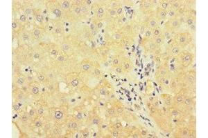 Immunohistochemistry of paraffin-embedded human liver cancer using ABIN7175178 at dilution of 1:100 (UVRAG 抗体  (AA 375-425))