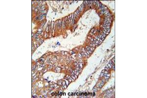 KLHL6 Antibody immunohistochemistry analysis in formalin fixed and paraffin embedded human colon carcinoma followed by peroxidase conjugation of the secondary antibody and DAB staining. (KLHL6 抗体  (C-Term))