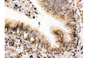 Anti- ERp57 Picoband antibody,IHC(P) IHC(P): Human Lung Cancer Tissue