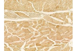 ABIN6257336 and ABIN6275089 at 1/100 staining human tongue carcinoma by IHC-P.
