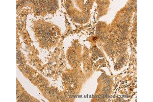 Immunohistochemistry of Human lung cancer using RPL26L1 Polyclonal Antibody at dilution of 1:30 (RPL26L1 抗体)