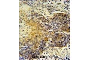 MRPS24 antibody (Center) (ABIN654454 and ABIN2844188) immunohistochemistry analysis in formalin fixed and paraffin embedded human lung carcinoma followed by peroxidase conjugation of the secondary antibody and DAB staining. (MRPS24 抗体  (AA 21-50))