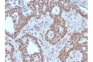 Formalin-fixed, paraffin-embedded human colon carcinoma stained with NRF1 Mouse Monoclonal Antibody (NRF1/2609). (NFE2L1 抗体)