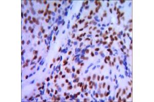 Immunohistochemical analysis of paraffin-embedded pancreatic cancer, using GATA1 mouse mAb with DAB staining. (GATA1 抗体)