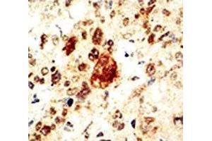 IHC analysis of FFPE human breast carcinoma tissue stained with the EphA1 antibody (EPHA1 抗体  (AA 913-943))