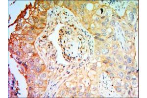 Immunohistochemical analysis of paraffin-embedded lung cancer tissues using PTK7 antibody with DAB staining. (PTK7 抗体)