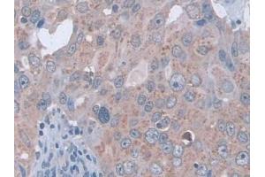IHC-P analysis of Human Breast cancer Tissue, with DAB staining. (D2HGDH 抗体  (AA 56-232))