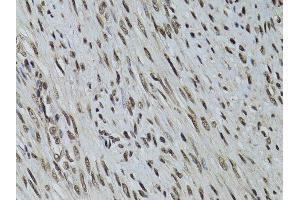 Immunohistochemistry of paraffin-embedded human uterine cancer using STK11 antibody.