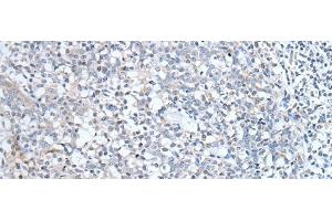 Immunohistochemistry of paraffin-embedded Human tonsil tissue using ABCD1 Polyclonal Antibody at dilution of 1:80(x200) (ABCD1 抗体)