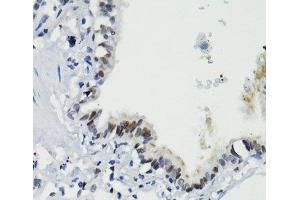 Immunohistochemistry (Paraffin-embedded Sections) (IHC (p)) image for anti-Signal Transducer and Activator of Transcription 3 (Acute-Phase Response Factor) (STAT3) (pSer727) antibody (ABIN7265216)