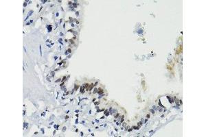 Immunohistochemistry of paraffin-embedded Human lung using Phospho-Stat3(S727) Polyclonal Antibody at dilution of 1:100 (40x lens). (STAT3 抗体  (pSer727))