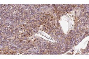 ABIN6273055 at 1/100 staining Human lymph cancer tissue by IHC-P. (MAVS 抗体  (C-Term))