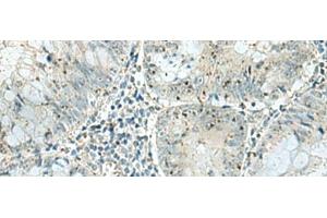 Immunohistochemistry of paraffin-embedded Human colorectal cancer tissue using PAK1IP1 Polyclonal Antibody at dilution of 1:120(x200) (PAK1IP1 抗体)