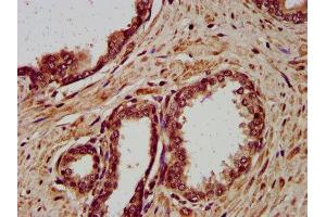 IHC image of ABIN7149771 diluted at 1:400 and staining in paraffin-embedded human prostate cancer performed on a Leica BondTM system. (Desmocollin 3 抗体  (AA 712-896))