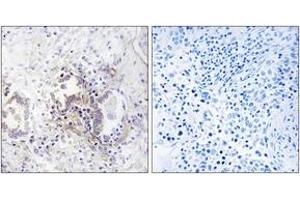 Immunohistochemistry analysis of paraffin-embedded human lung carcinoma tissue, using CHML Antibody. (CHML 抗体  (AA 128-177))