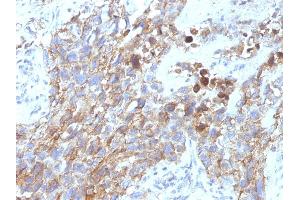 Formalin-fixed, paraffin-embedded human Lung Carcinoma stained with CD56 Mouse Monoclonal Antibody (NCAM1/795). (CD56 抗体)