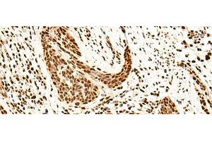 Immunohistochemistry of paraffin-embedded Human esophagus cancer tissue using SNRPB2 Polyclonal Antibody at dilution of 1:75(x200) (SNRPB2 抗体)