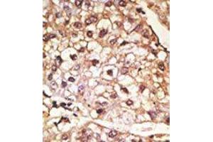 Formalin-fixed and paraffin-embedded human cancer tissue reacted with the primary antibody, which was peroxidase-conjugated to the secondary antibody, followed by AEC staining. (SNCA 抗体  (C-Term))