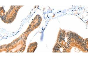 Immunohistochemistry of paraffin-embedded Human colon cancer tissue using ACOX3 Polyclonal Antibody at dilution 1:35 (ACOX3 抗体)