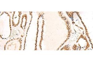 Immunohistochemistry of paraffin-embedded Human thyroid cancer tissue using DCAF10 Polyclonal Antibody at dilution of 1:130(x200) (DCAF10 抗体)