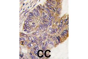 Formalin-fixed and paraffin-embedded human colon carcinoma tissue reacted with RPS6KA1 polyclonal antibody  , which was peroxidase-conjugated to the secondary antibody, followed by DAB staining. (RPS6KA1 抗体  (Ser732))