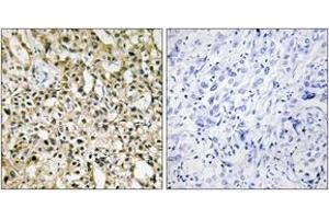 Immunohistochemistry analysis of paraffin-embedded human liver carcinoma tissue, using MYC Antibody. (c-MYC 抗体  (AA 386-435))