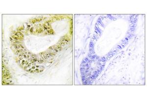 Immunohistochemistry analysis of paraffin-embedded human colon carcinoma tissue using ZNF638 antibody. (ZNF638 抗体  (Internal Region))