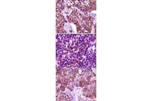 Immunohistochemical analysis of paraffin-embedded human lung carcinoma (A), lymph tissue (B) and skin carcinoma tissue (C), showing membrane localization, using BLK monoclonal antibody, clone 9D10B7H6, 9D10A8F8  with DAB staining.