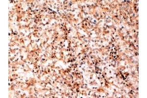 ABIN184741 (2 µg/mL) staining of paraffin embedded Human Kidney cancer. (TFEB 抗体  (N-Term))