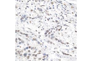Immunohistochemistry of paraffin-embedded human esophageal cancer using [KO Validated] L3MBTL3 Rabbit pAb (ABIN6132145, ABIN6143061, ABIN6143062 and ABIN6223119) at dilution of 1:50 (40x lens). (L3MBTL3 抗体  (AA 1-230))