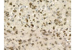 ABIN6260720 and ABIN6276822 at 1/100 staining human melanoma by IHC-P. (CDK7 抗体  (Internal Region))