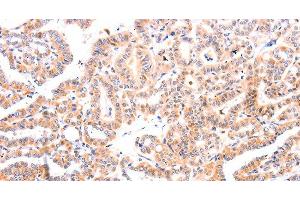 Immunohistochemistry of paraffin-embedded Human thyroid cancer tissue using Ephrin A1 Polyclonal Antibody at dilution 1:37 (Ephrin A1 抗体)