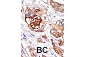 Formalin-fixed and paraffin-embedded human cancer tissue reacted with the primary antibody, which was peroxidase-conjugated to the secondary antibody, followed by DAB staining. (Mps1 抗体  (N-Term))