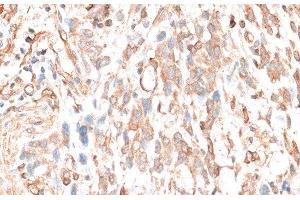 Immunohistochemistry of paraffin-embedded Human gastric cancer using CDH11 Polyclonal Antibody at dilution of 1:100 (40x lens). (OB Cadherin 抗体)