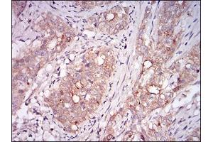 Immunohistochemical analysis of paraffin-embedded cervical cancer tissues using MSTN mouse mAb with DAB staining. (MSTN 抗体  (AA 24-266))