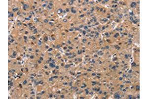 The image on the left is immunohistochemistry of paraffin-embedded Human liver cancer tissue using ABIN7189936(ATP7A Antibody) at dilution 1/50, on the right is treated with synthetic peptide. (ATP7A 抗体)