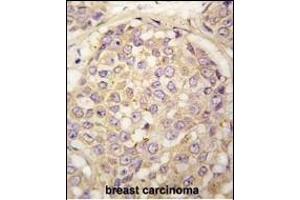 Forlin-fixed and paraffin-embedded hun breast carcino tissue reacted with GEA4 antibody (N-term) (ABIN390108 and ABIN2840620) , which was peroxidase-conjugated to the secondary antibody, followed by DAB staining. (MAGEA4 抗体  (N-Term))