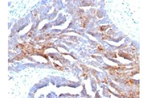IHC staining of human ovarian carcinoma with TAG-72 antibody